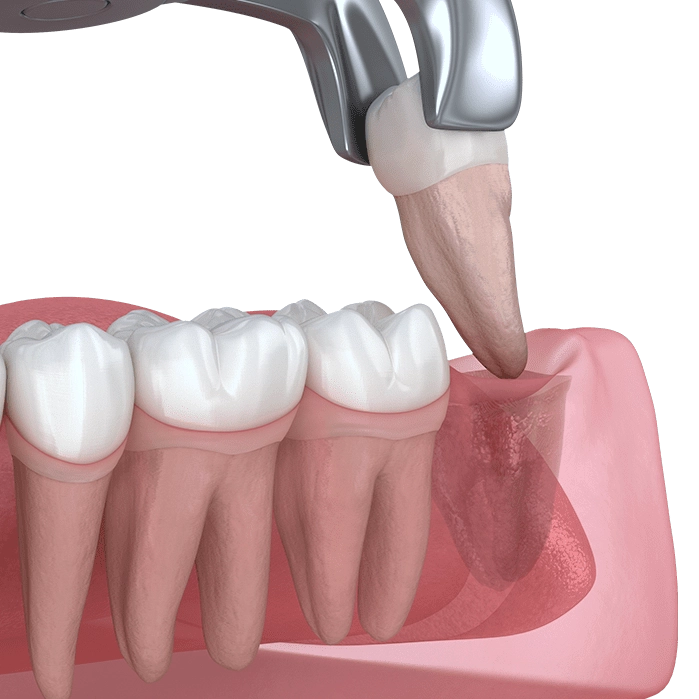 В чому складність видалення зуба мудрості? - блог